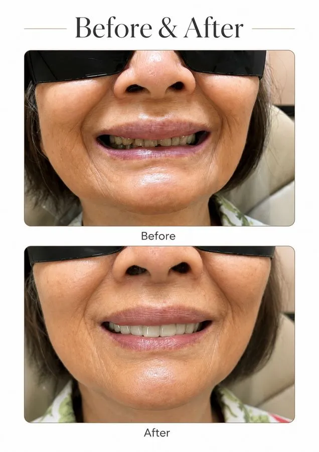 Before and after: Smile Makeover — SoftDental Houston, real patient case with signed consent