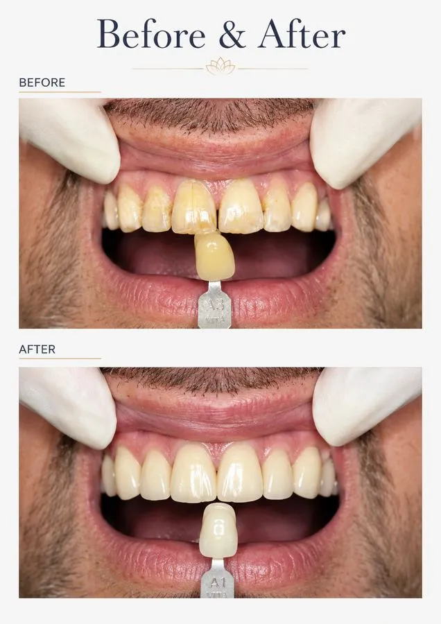 Before and after: Veneers — Shade A3 to A1 — SoftDental Houston, real patient case with signed consent