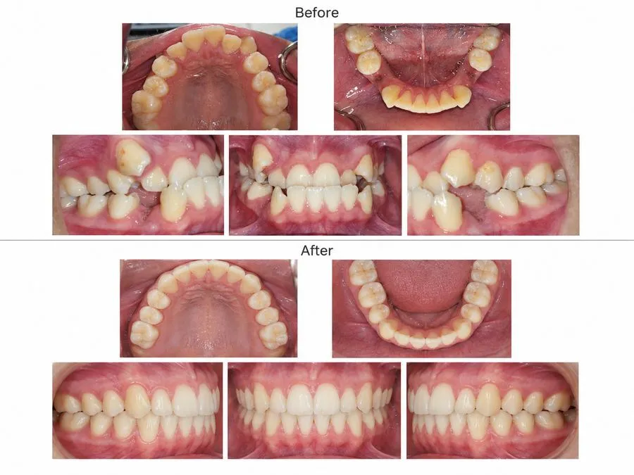 Before and after: Traditional Braces — SoftDental Houston, real patient case with signed consent