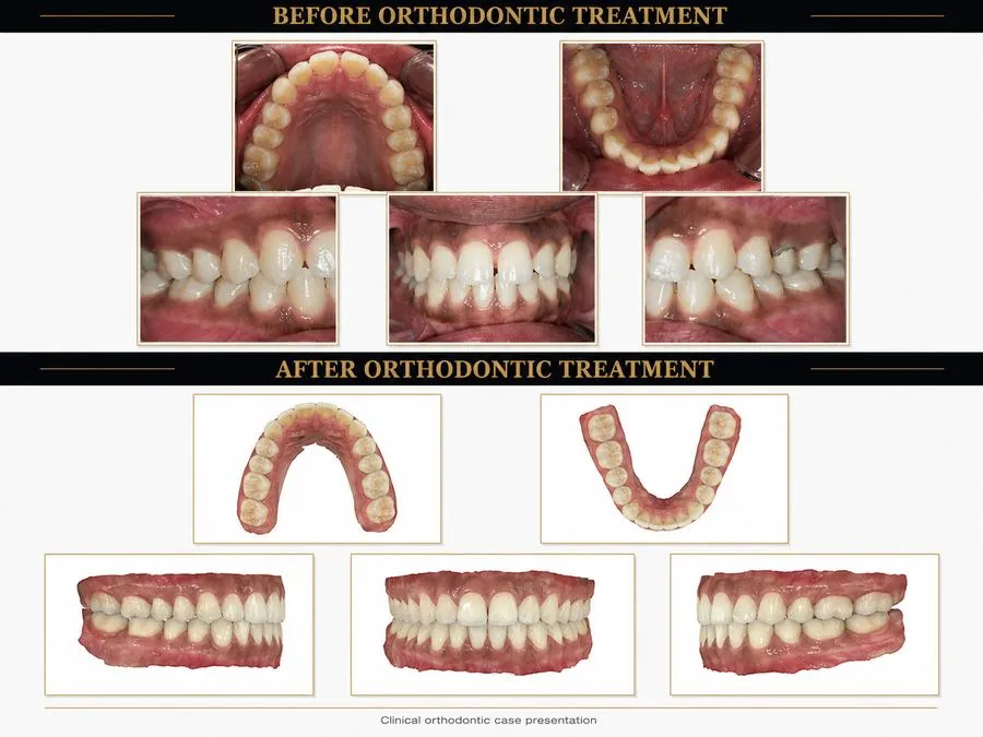 Before and after: Invisalign Treatment — SoftDental Houston, real patient case with signed consent