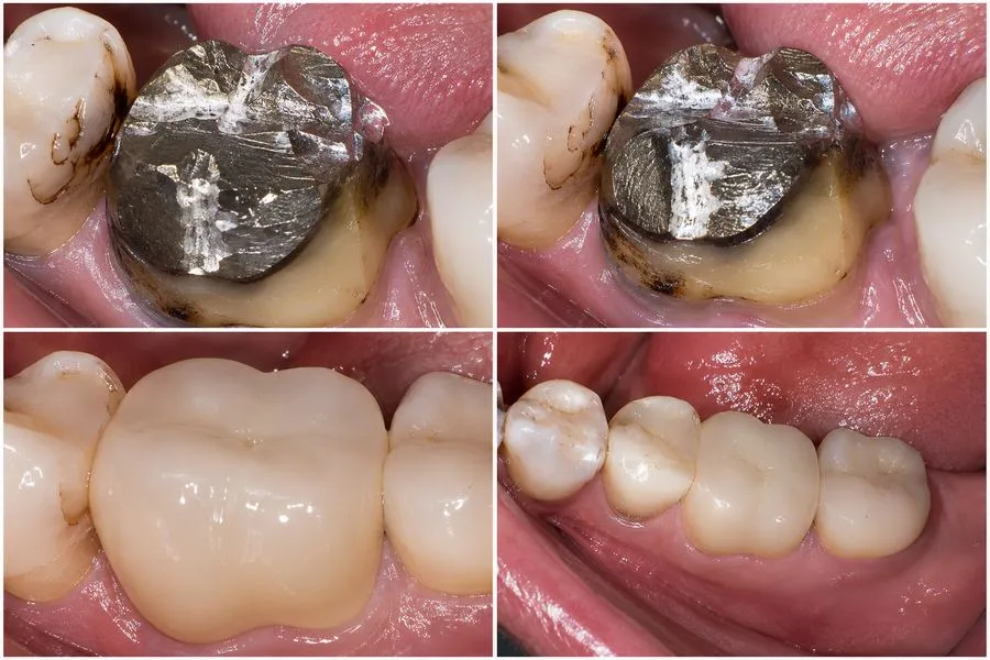 Before and after: Crown Replacement — SoftDental Houston, real patient case with signed consent