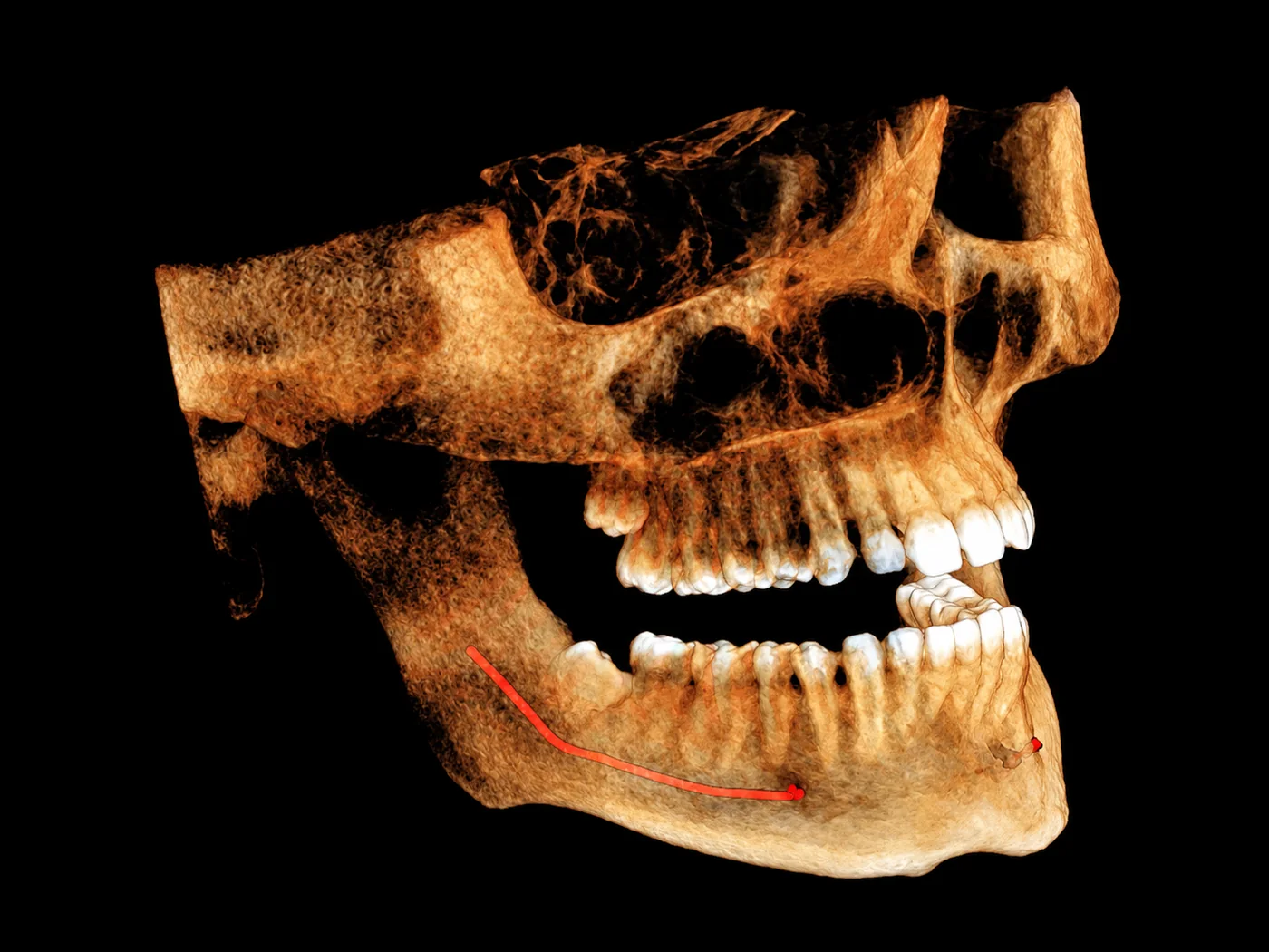 An Anatomage Cone-beam CT 3D rendering of a patient's jaw and skull, showing the inferior alveolar nerve marked in red for surgical planning